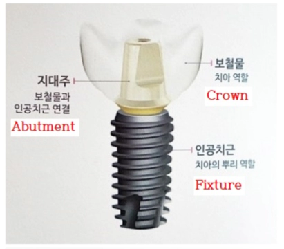 임플란트의 구조 이미지