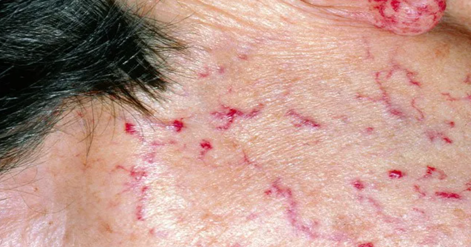 유전성 출혈성 모세혈관 확장증 환자의 얼굴에 나타난 증상