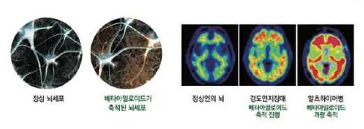 정상 vs 알츠하이머 뇌 비교