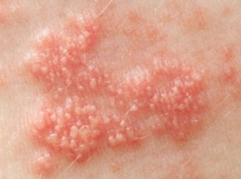 대상포진 예방접종 - 치매&middot;심장병까지 예방? 