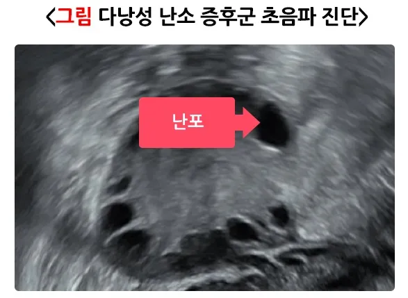 다낭성 난소증후군