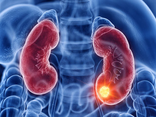 루프스 병 (systemic lupus erythematosus), 전신성 홍반성 원인과 증상에 대해 알아봤습니다. 매우 생소한 이름인데요. 얼굴에 나비 모양으로 발진이 일어났다면 한번쯤은 의심해봐야 합니다. 루프스 병은 어디 병원으로 가야 하는지와 치료방법까지 천천히 읽어 보시기 바랍니다.