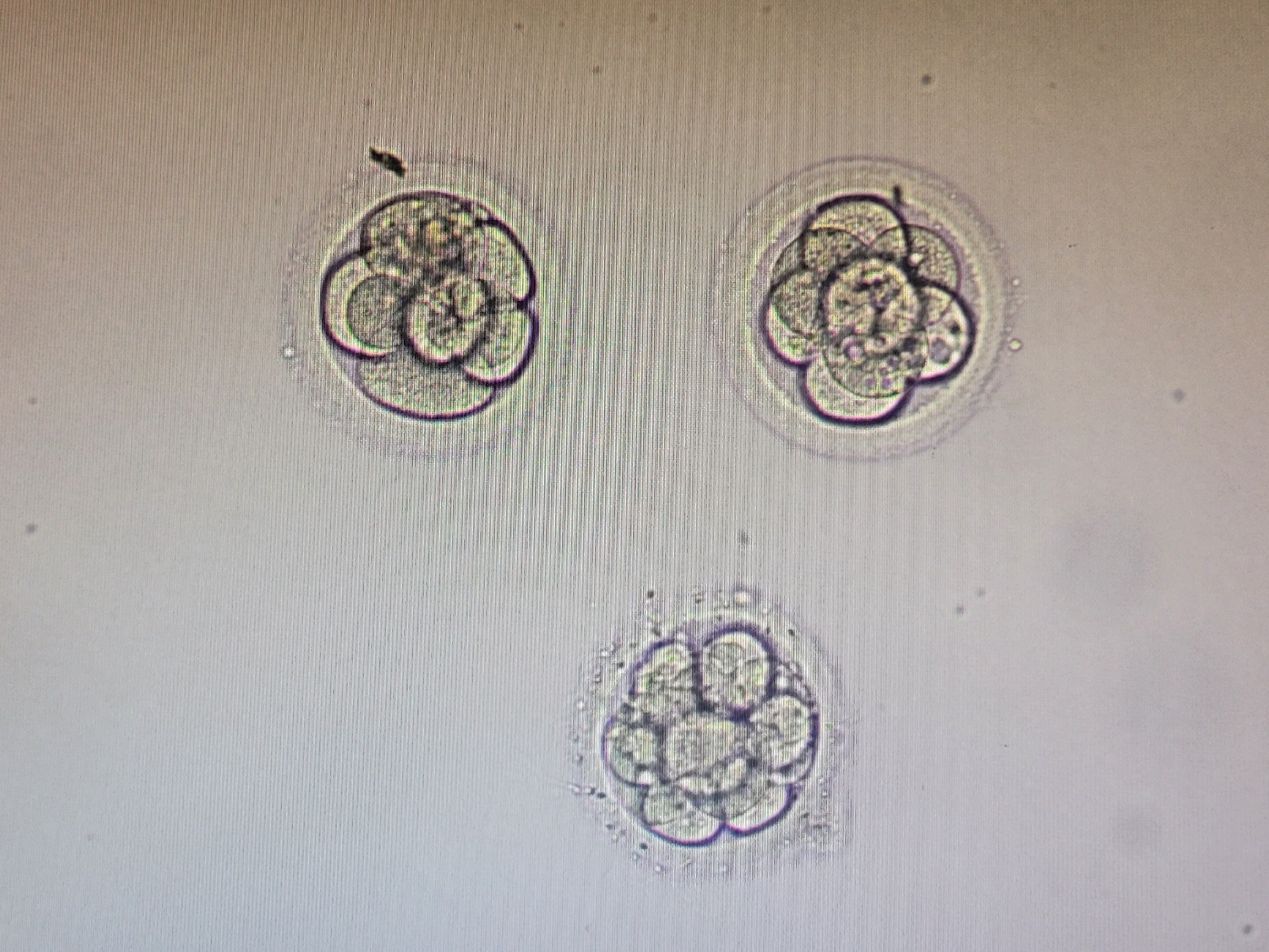 시험관 1차 _ 3일 배아 신선이식