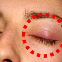 다래끼-난-사진