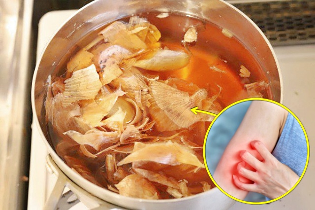 양파 껍질 효능, 피부염증, 양파 껍질차 효능, 양파 껍질 끓인물 효능, 건강 팁줌 매일꿀정보