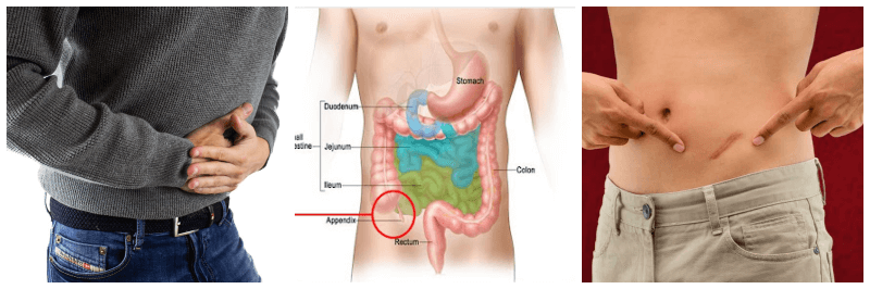 충수염 관련 사진 3개