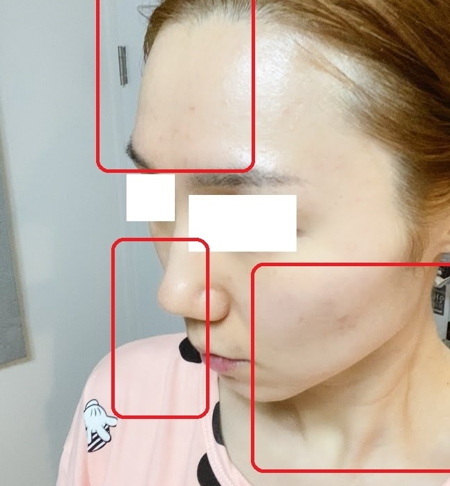 얼굴지방이식후기