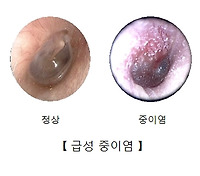중이염 증상