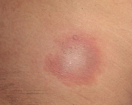 올해 국내 첫 라임병 환자 발생, 증상 및 원인, 예방법