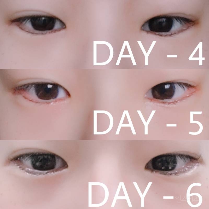 안검내반수술 후기