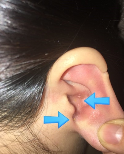 귀 대상포진 증상 후유증