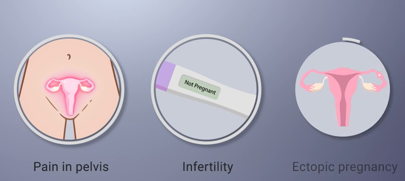 클라미디아 감염 경로