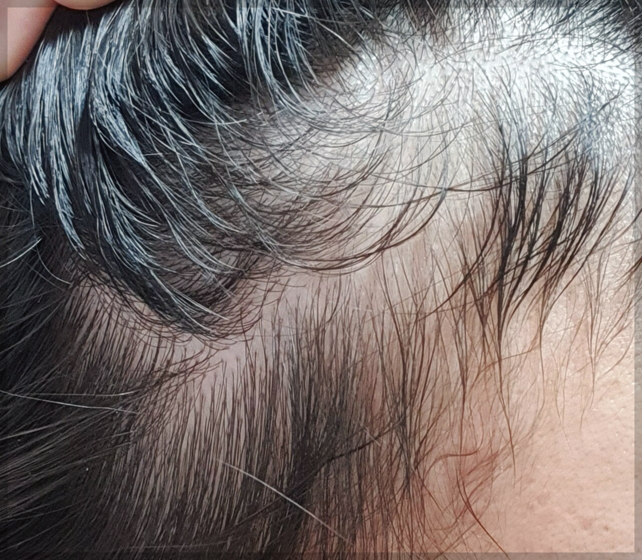 로게인폼-가격-로게인폼-부작용