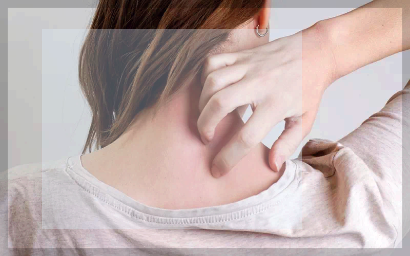 대상포진 후유증 가려움_