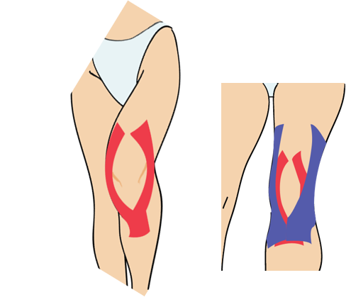 무릎 통증(운동장해원인)