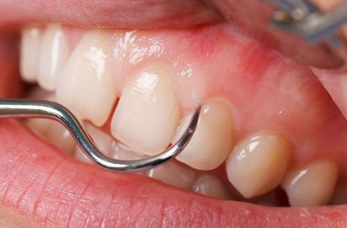 잇몸 치아 스케일링 (출처 : Pinterest)
