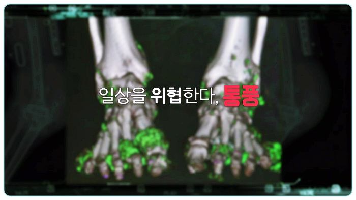 건강-고요산혈증-통풍에-좋은-음식과-식이요법-4가지