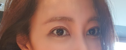 상안검 수술 후기