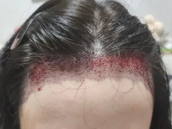 머리카락 이식 3000모 3000모낭 비용과 시술 과정_15
