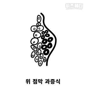 위저선 용종