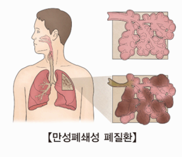 만성 폐쇄성 폐질환 이미지사진
