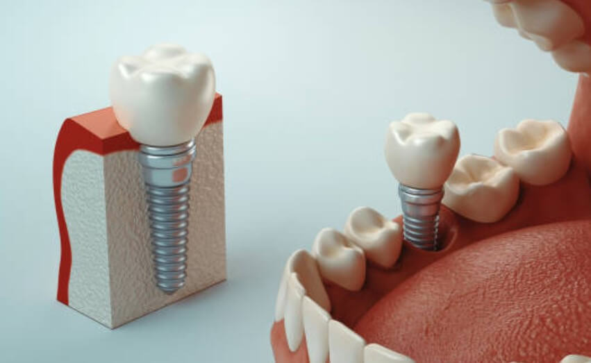 임플란트 잇몸뼈