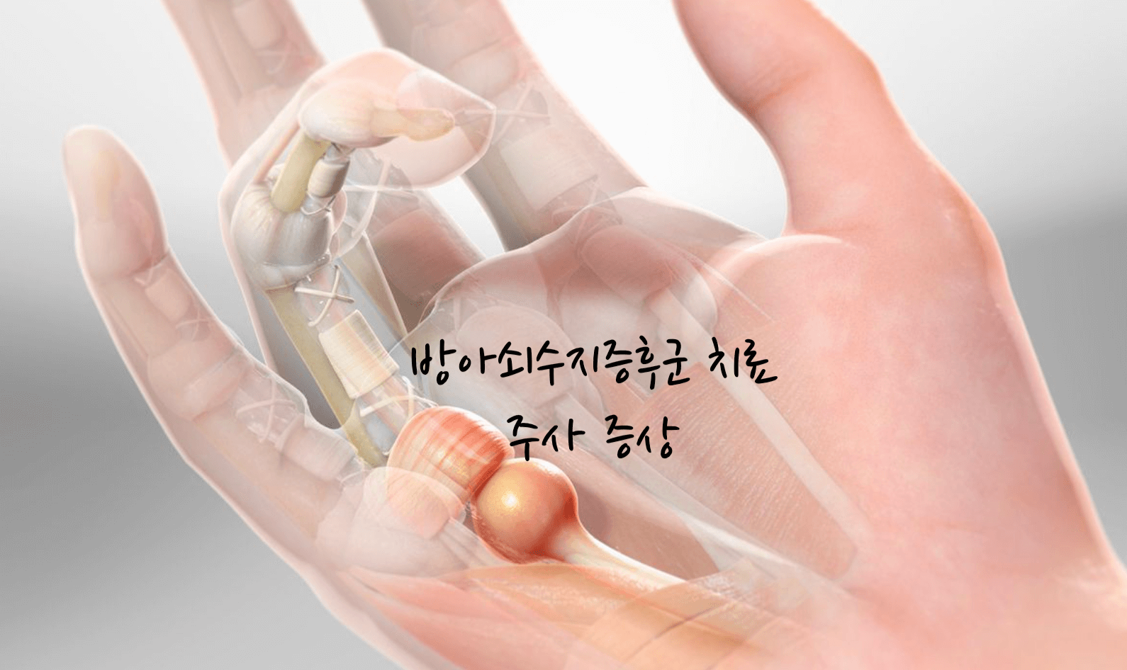 방아쇠수지증후군