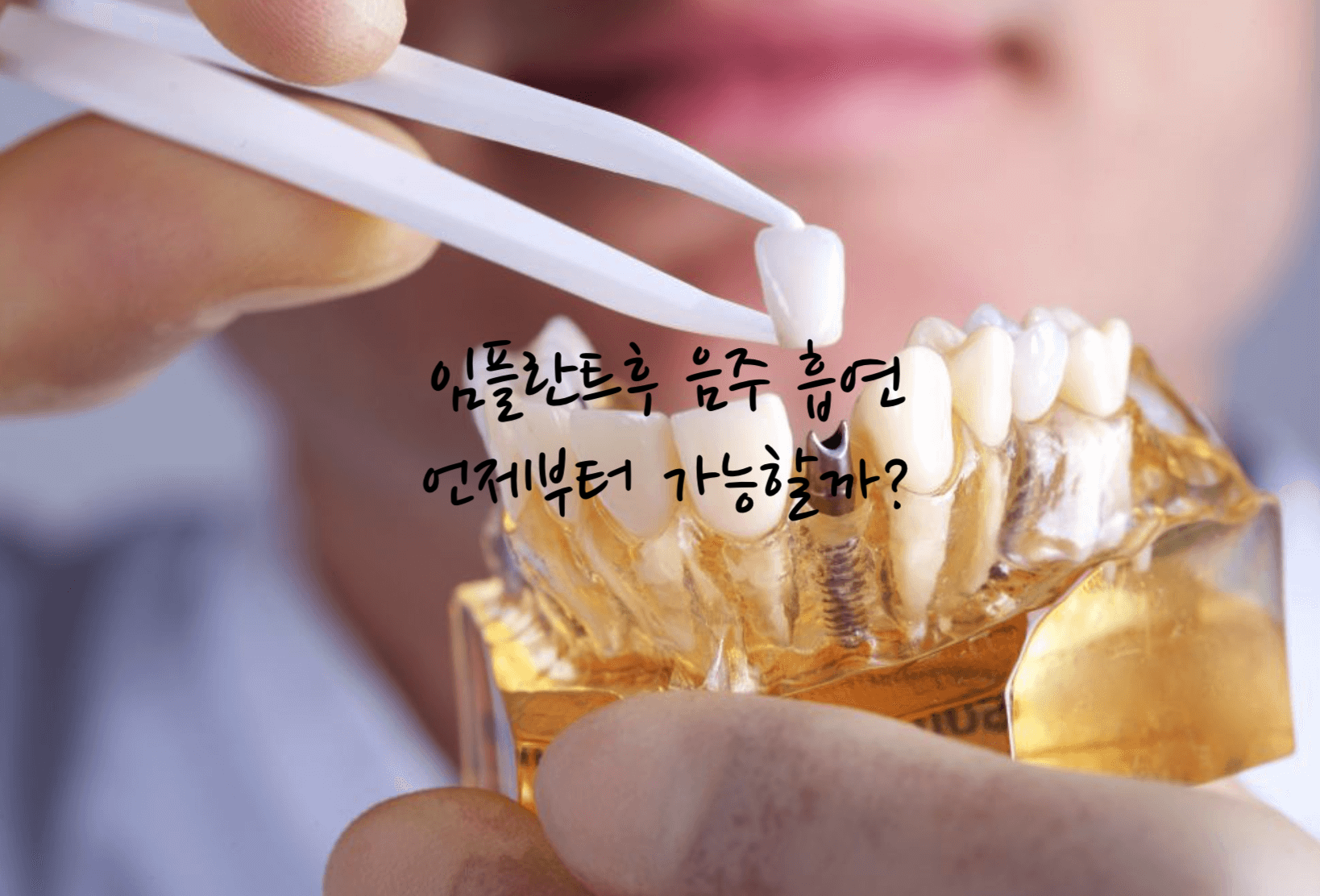 임플란트후 관리