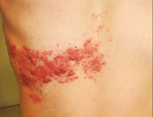 대상포진 초기증상 대상포진 조기치료 대상포진 초기증상 및 조기치료