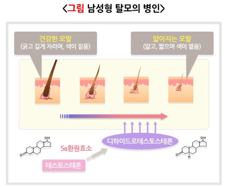 남성형-탈모의-병인을-그림으로-그린-사진