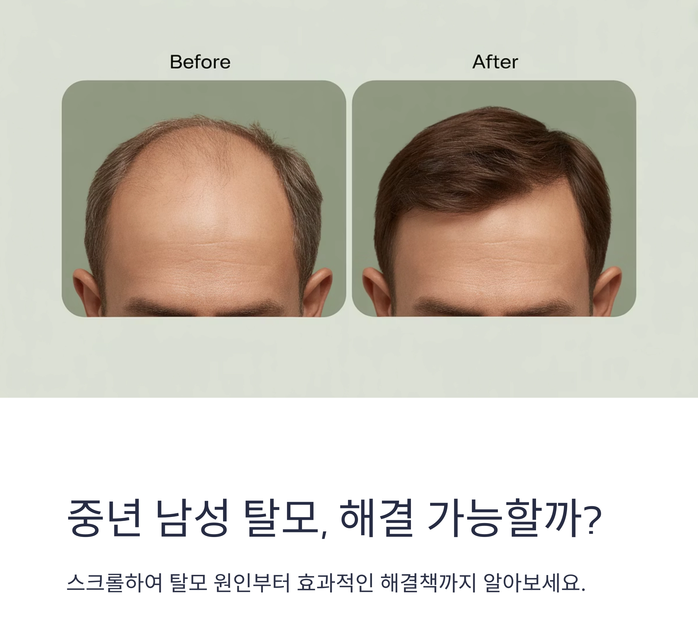 중년 남성 탈모, 과연 해결할 수 있을까? 효과적인 방법 총정리