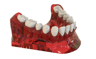 임플란트 추가 비용 요소