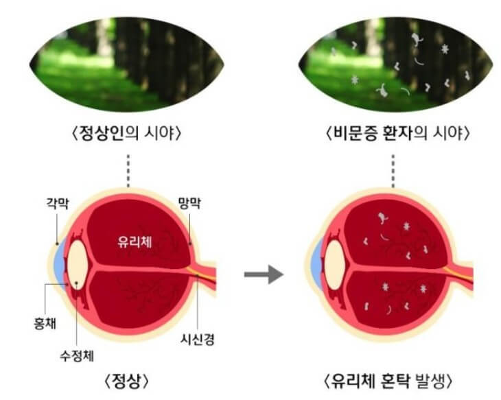 정상인과 비문증 환자의 증상 비교