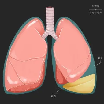 폐에 물이 차는 원인 증상 물참 관리 포인트에 대한 건강정보_5