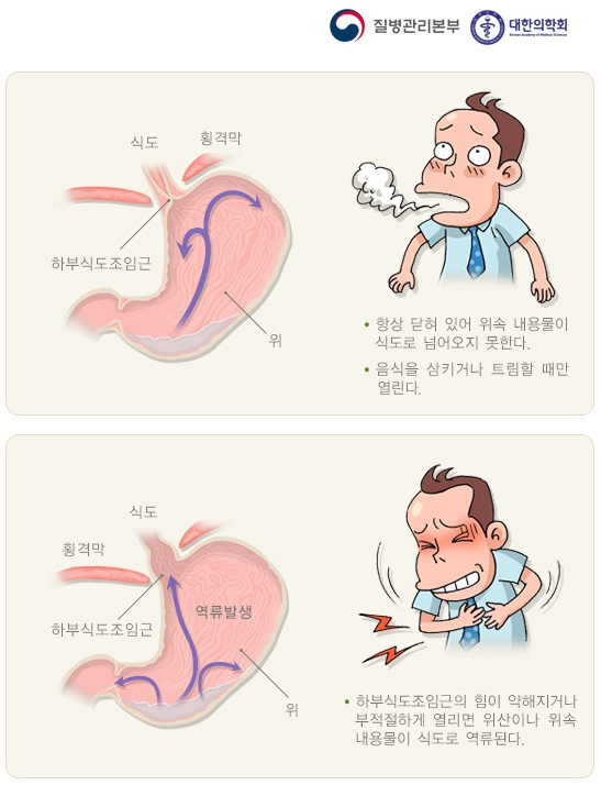 위식도 역류 질환의 원인과 증상, 진단, 치료와 예방 방법, 합병증