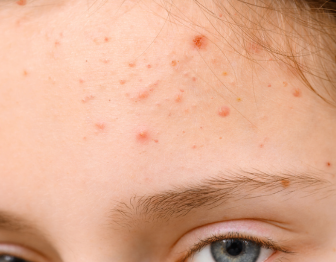 스티바에이크림 효과