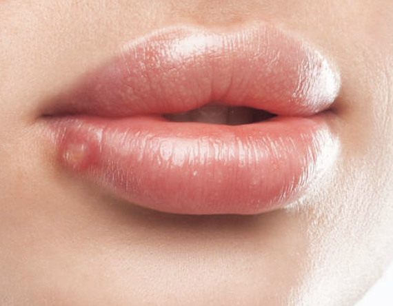 입술에 물집이 생기는 이유 9