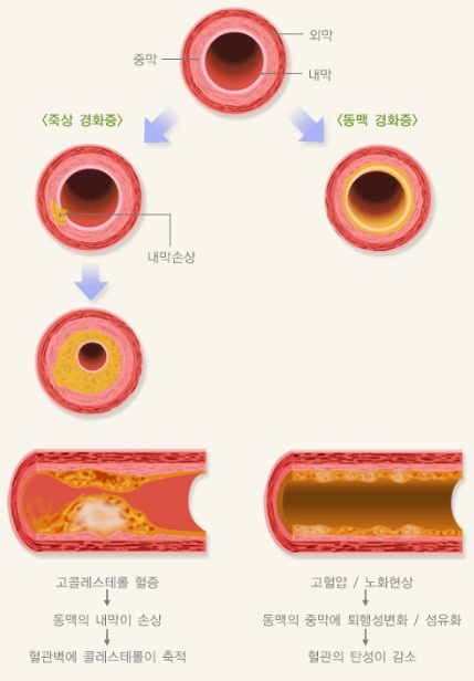 관상동맥 내벽에 콜레스테롤이 쌓여 혈관이 좁아지는 죽상동맥경화증 진행 과정