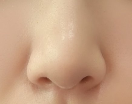 콧볼 보톡스 후기