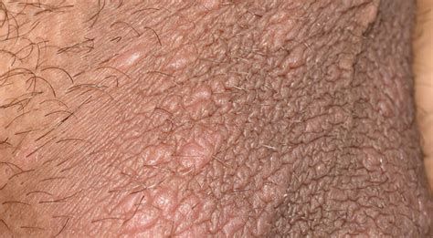 남자 사타구니 습진