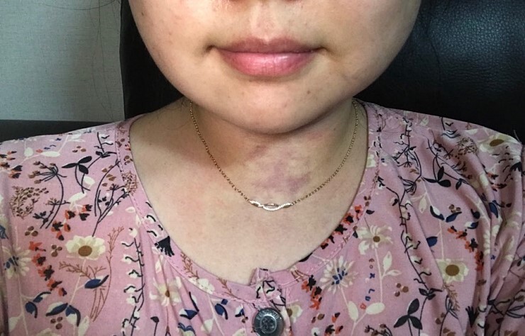 턱살지방흡입 후기