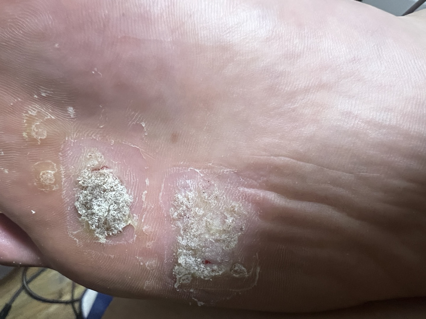 사마귀 냉동치료