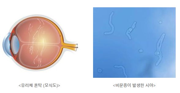 비문증원인