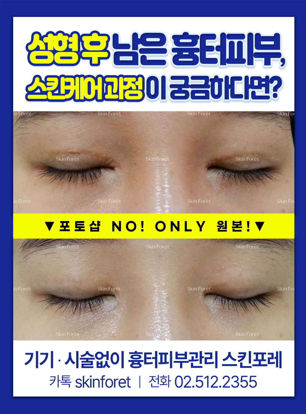 눈 재수술 전 오래된 흉터 케어, 스킨포레