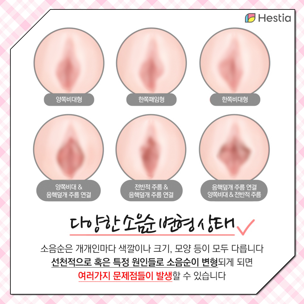 다양한 소음순 변형 상태
