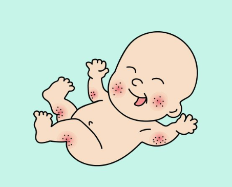 땀띠