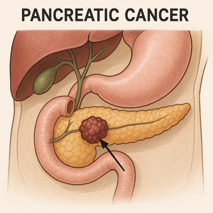 췌장암 관련 자료 사진