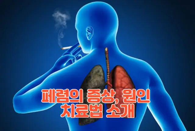 페렴의 증상과 원인을 파악 후 치료법에 대한 내용 소개