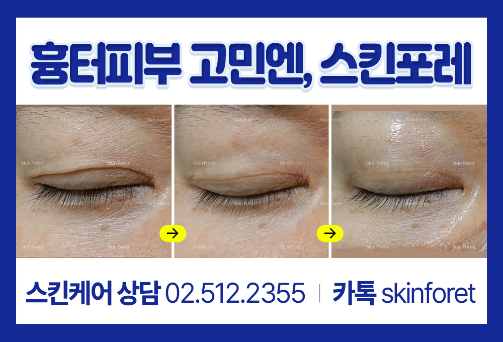 눈꺼풀 절개 부위에 남은 흉살의 흐름을 자연스럽게 정돈한 skinforet 내돈내산 쌍꺼풀흉터 관리