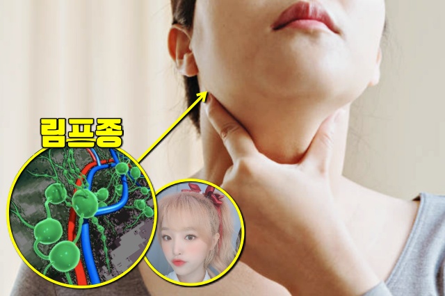 목 겨드랑이 붓기,림프종 증상 원인,허지웅 아이즈원 최예나,건강,팁줌 매일꿀정보